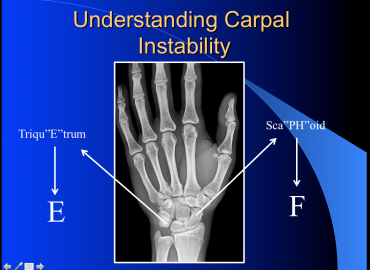 Understanding the carpal instability